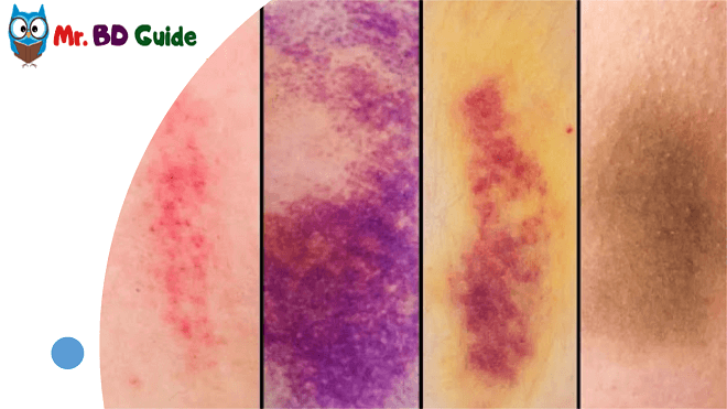 How to Give Yourself a Bruise Anywhere on Your Body Step-by-Step Instructions 5 Color Stages of a Bruise Image - Mr. BD Guide