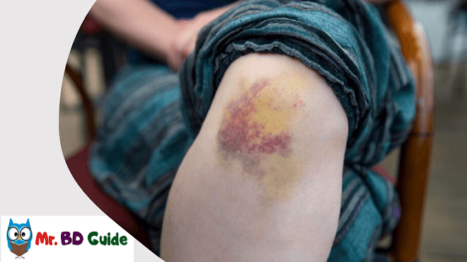 Create a Bruise on Your Knee Image - Mr. BD Guide