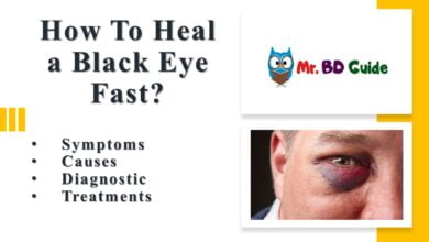 How To Heal a Black Eye Fast? 2 How To Heal a Black Eye Fast Featured Image - Mr. BD Guide